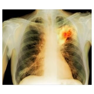 Wall Art  Posters  Lung abscess, X ray Poster